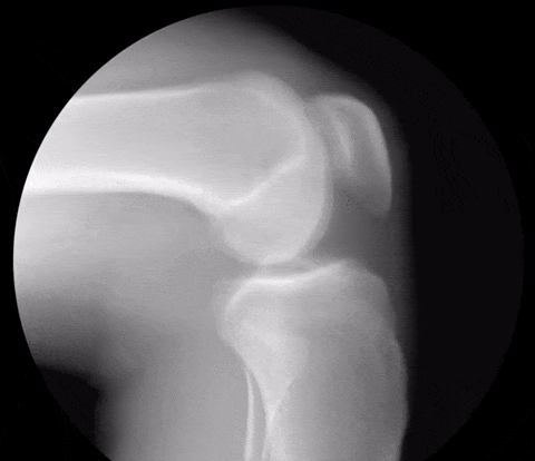bewegend röntgenbeeld kniegewricht