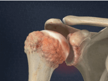 arthrose schouderprothese fysiotherapie middenweg amsterdam oost